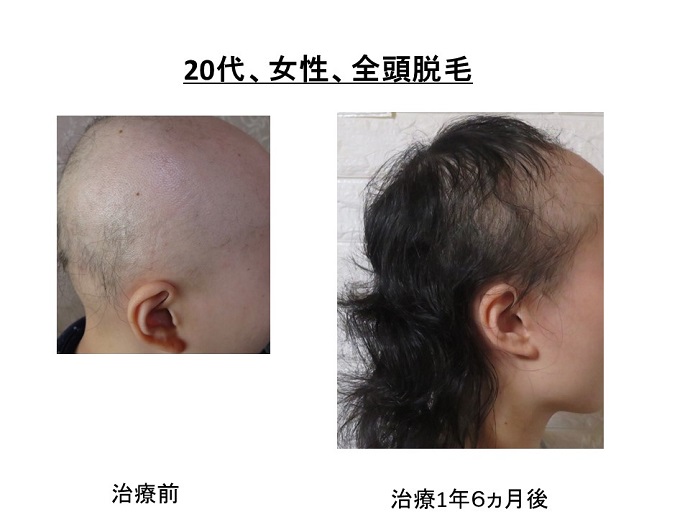 円形脱毛症　病院